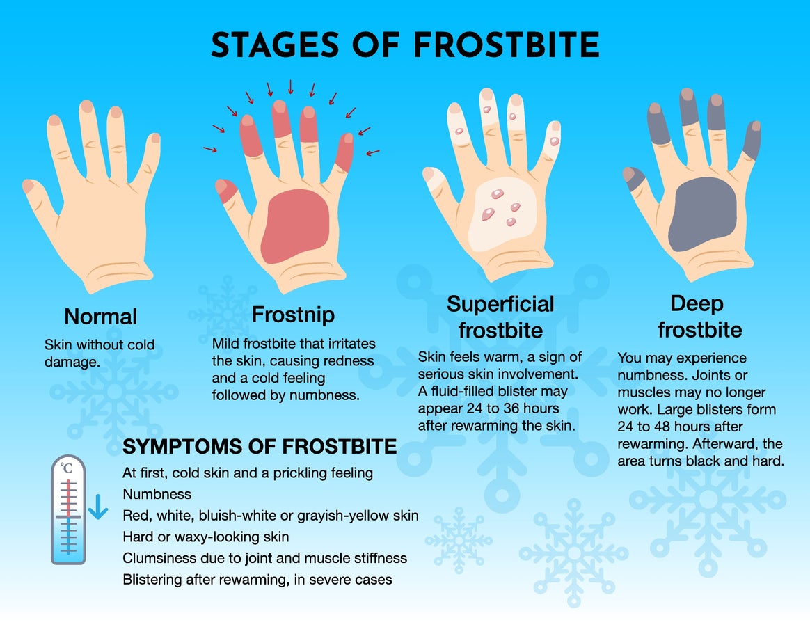 Essential Guide to How Long It Takes to Get Frostbite: Important Insights for 2025