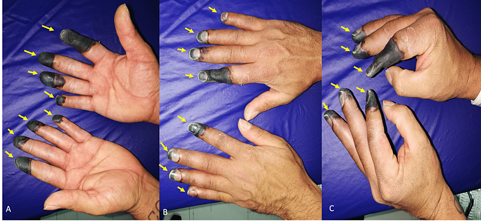 Frostbite Symptoms