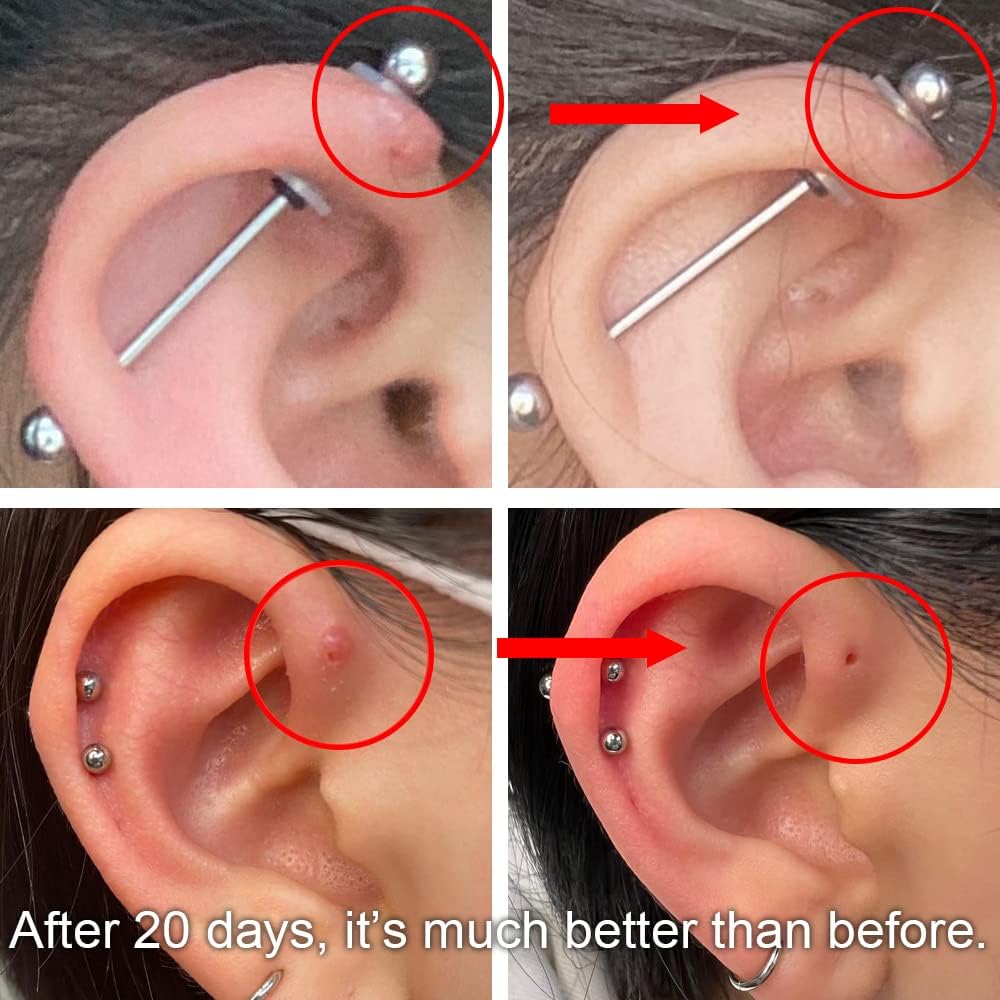 Effective Ways to Get Rid of a Piercing Bump in 2025: Discover Proven Solutions to Succeed