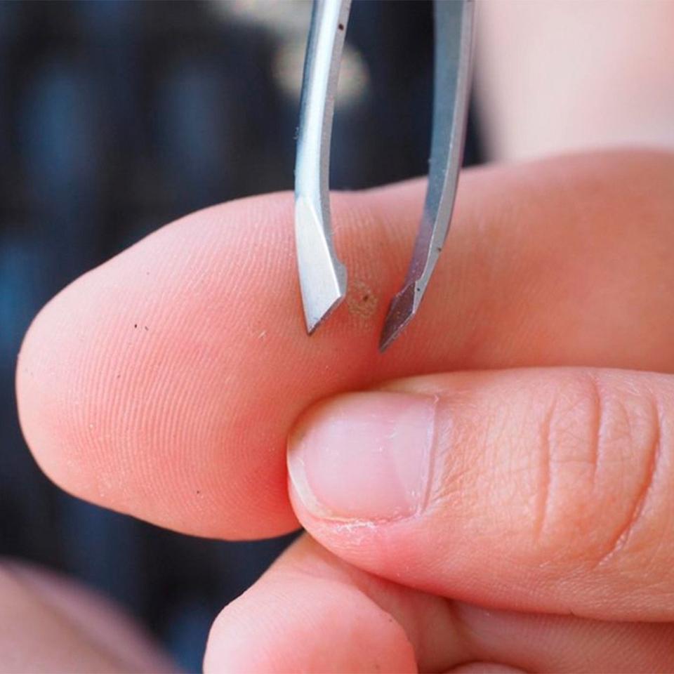 Smart Ways to Remove a Splinter You Can’t See in 2025 – Explore Proven Techniques!